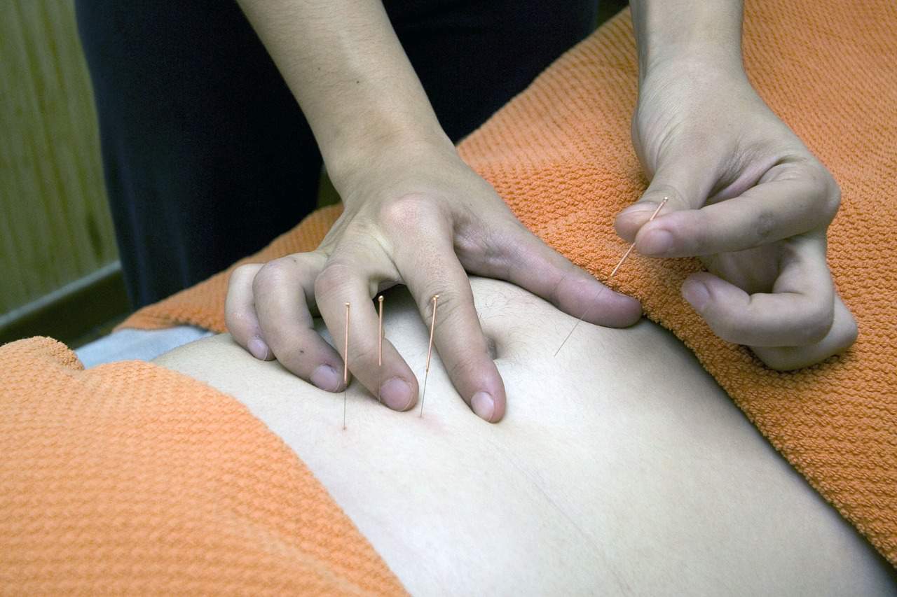 acupuncture session